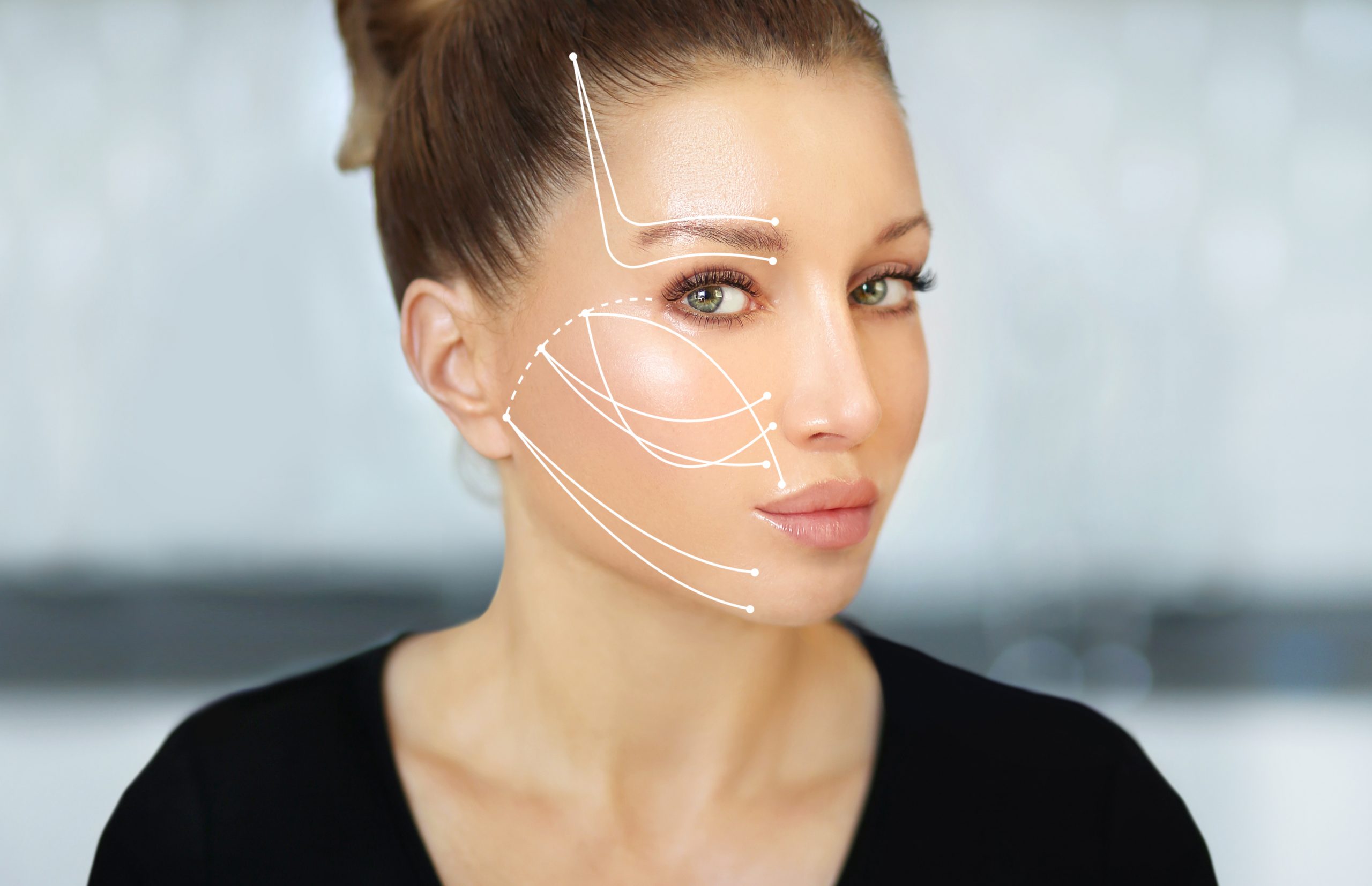 Kinnlinienlifting - Fadenlifting mit Silhouette Soft