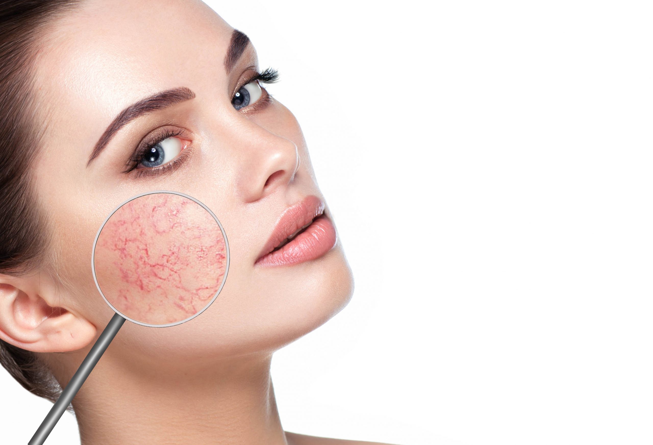 Rosacea Behandlung 1090 Wien